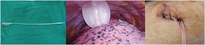 Safety and Feasibility of Video-Assisted Thoracoscopic Day Surgery and Inpatient Surgery in Patients With Non-small Cell Lung Cancer: A Single-Center Retrospective Cohort Study